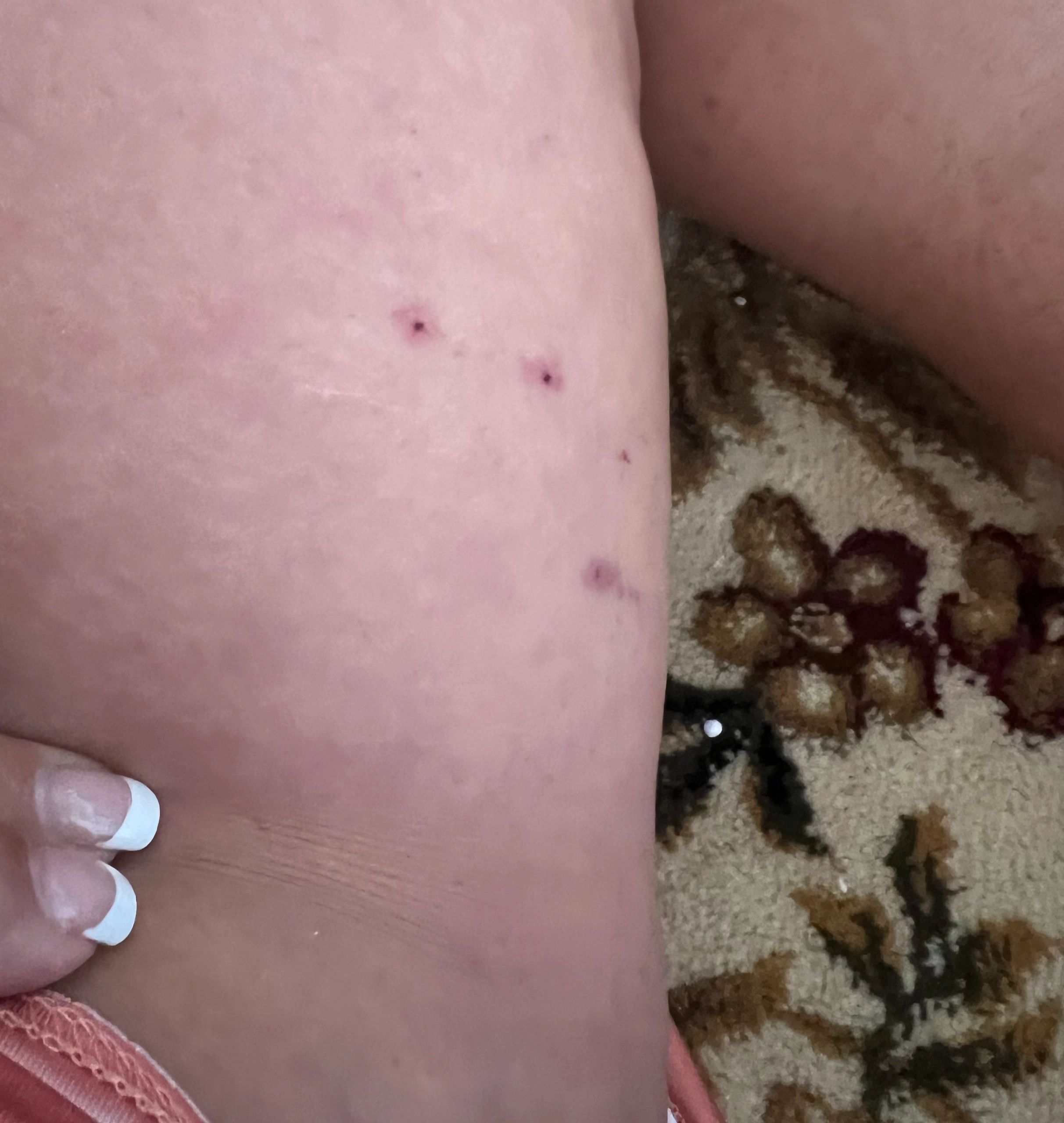 Close-up of three reddish marks on an inner thigh, with a patterned rug beside it.